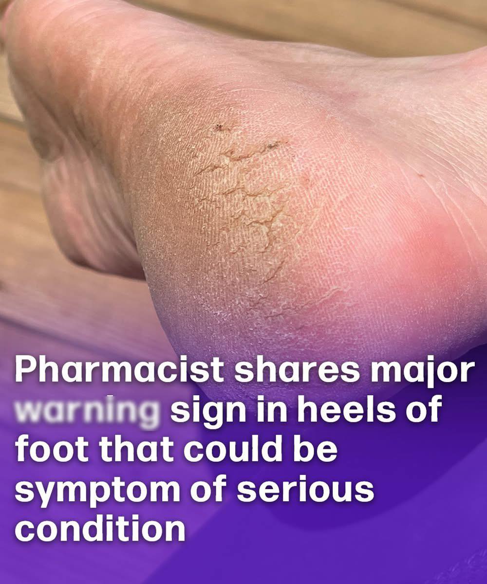 Cracked Heels Could Be a Warning Sign