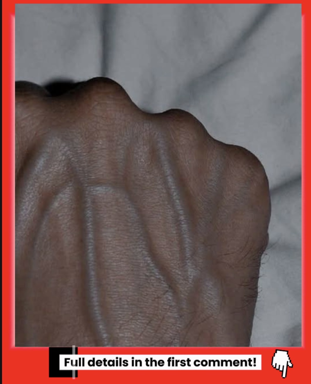 Why Your Veins Become More Visible and What It Means for Your Health