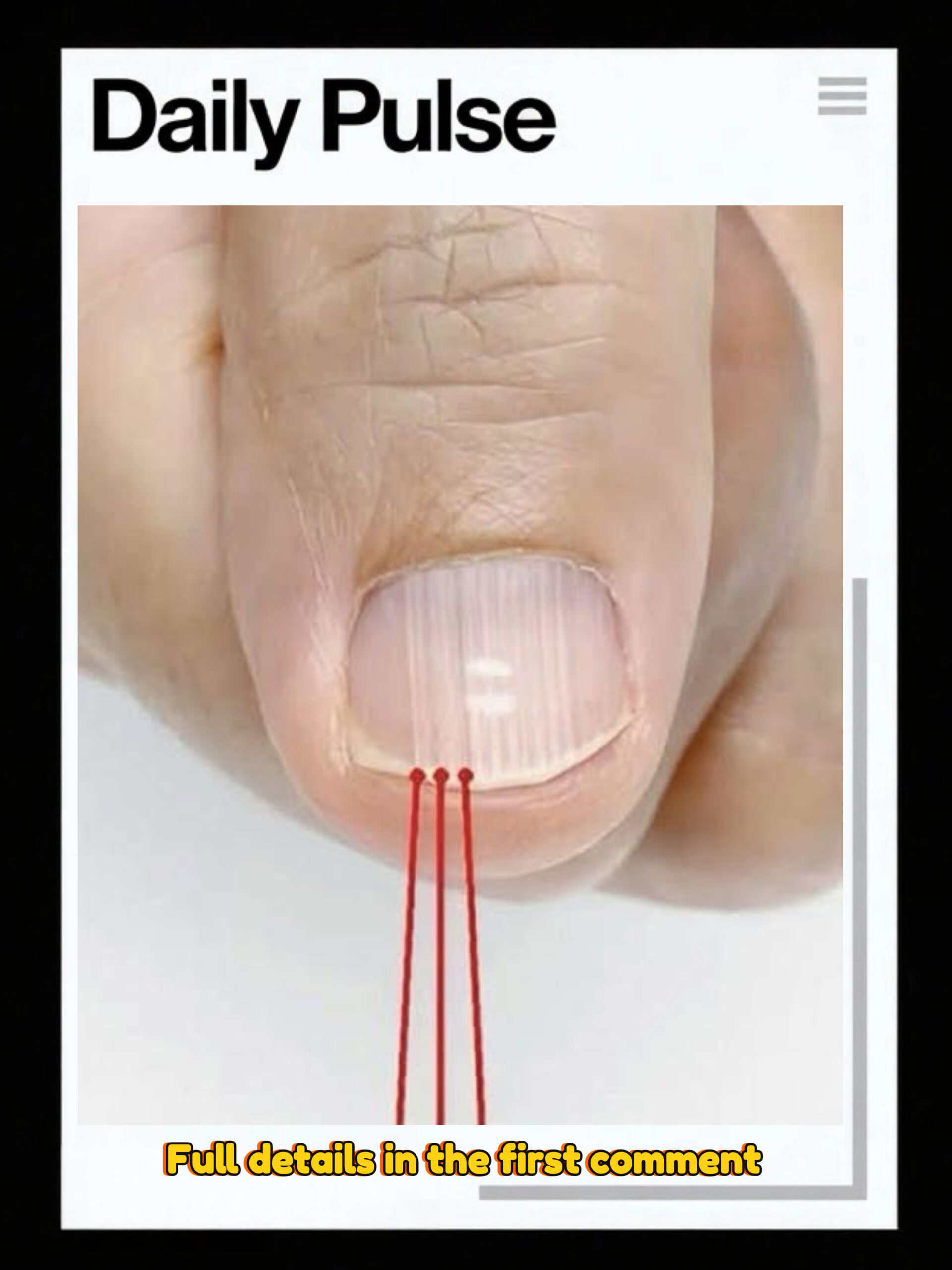 Vertical Nail Ridges: Normal Changes and Nail Health